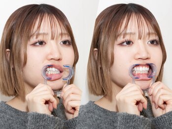 シュシュ(chouchou)/ホワイトニングSTEP ５