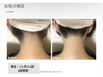 リネ(Rine)/before→after