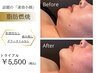 NEW★脂肪燃焼究極小顔コース【高濃度40％脂肪分解セラム使用】