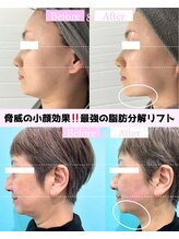 カンナムビューティー オンダ 瞬間小顔