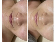 リュミエール(umiere)/赤み、凹凸、ニキビケア