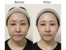 ココロ(COCORO)/たるみの救世主★