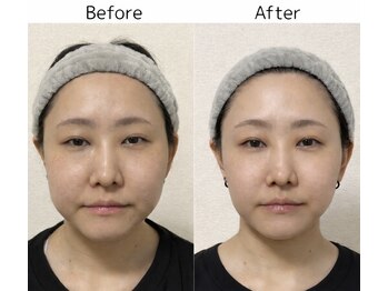 ココロ(COCORO)/たるみの救世主★