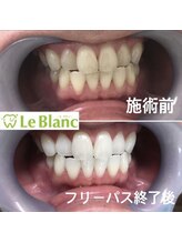 ルブラン 奈良店(Le Blanc)/歯が白くなった後は。。。