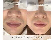 ゼロ アンド リセット(0ZERO&RESET)/【メンズ脱毛】0ZERO&RESET