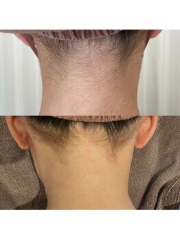 ウルル(ULuLu)/うなじ脱毛4回目