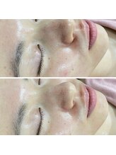 ファーファラ(Farfalla)/ピーリング