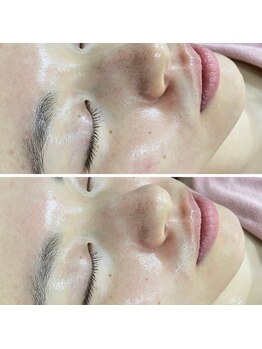 ファーファラ(Farfalla)/ピーリング