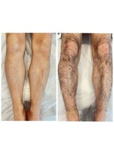 ラウレア(Laule'a)/メンズ脱毛！足ワックス脱毛