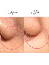 ビズビズ 天王寺店(bisebise)/〈症例〉小鼻下の赤み/肌キメ