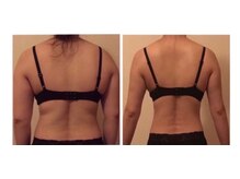 ラディス(Radice.)の雰囲気（背中のお肉をバストへ移動☆体重変化なし！バスト３カップUP）