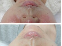 シミ・毛穴改善&美白フェイシャルサロン/肌質改善を目指す！