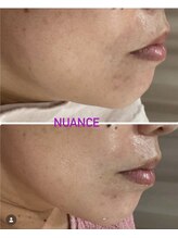 エーエフビューティーエステ(AF Beauty Esthetic)/NUANCEリフトフェイシャル