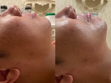 エステサロン ジョアアンジェ(joie ange)/レモンボトルの最新版