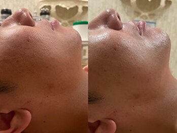 エステサロン ジョアアンジェ(joie ange)/レモンボトルの最新版