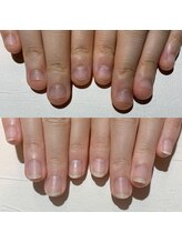 アティックネイルアトリエ(attic nail atelier)/深爪改善コース