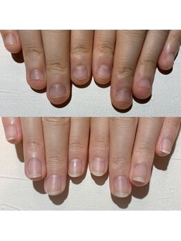 アティックネイルアトリエ(attic nail atelier)/深爪改善コース
