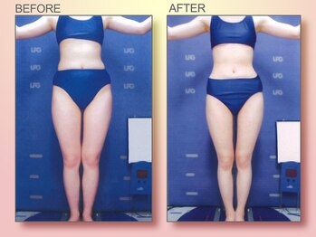 ジュリア オージェ 天王寺店/ビフォーアフター（脂肪燃焼）