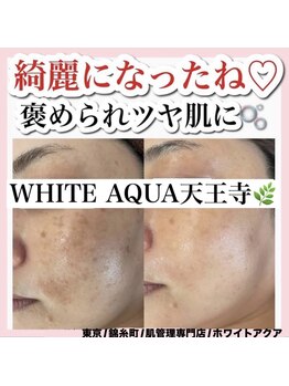 ホワイトアクア 錦糸町店(WHITE AQUA)/ハーブピーリング/東京/錦糸町