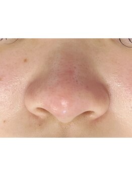 毛穴ケアをしたい