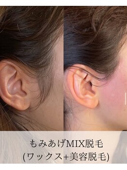 ハナサクラ 心斎橋(HANASAKURA)/大人気★もみあげワックス脱毛