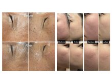 サマラボ 三軒茶屋(Sama Labo)/Before→After(シワ、赤ら顔)