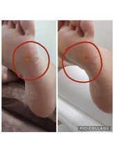 遊歩堂/小指下魚の目