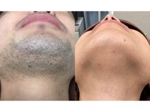 【ヒゲ脱毛効果※回数目安１５回】