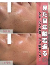 ジーニー(genie)/低周波シミケア×生幹細胞導入