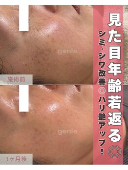 ジーニー(genie)/低周波シミケア×生幹細胞導入