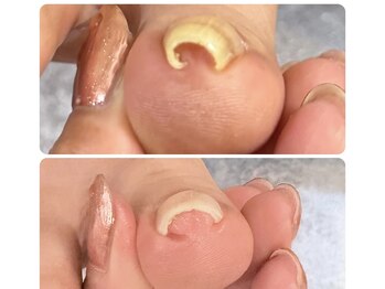 オト(oto)の写真/巻き爪や、噛み爪などの爪悩みを徹底ケア！福祉ネイリスト在籍でシニア・高齢者の方の爪ケアもぜひ任せを◎