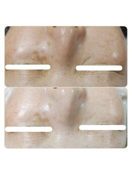 アンティクイーン(Antiqueen)/シミ、透明感、トーンアップ