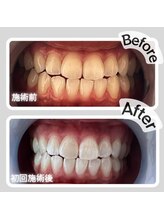 ザ ホワイト(THE WHITE)/ビフォーアフター初回