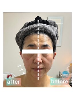 ルクール(Le Couer)/ラジオ波