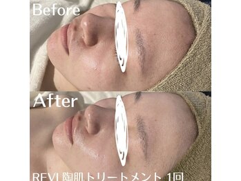 ホワイトアクア 中目黒店(WHITE AQUA)/ハーブピーリング/毛穴/中目黒