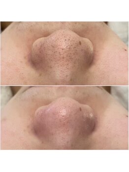 メゾンリュバン 梅田店(Maison Ruban)/毛穴洗浄・美白フォト|毛穴ケア