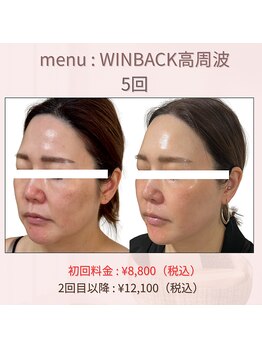 タルボ(TALBO)/WINBACKたるみ小顔美容
