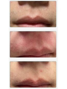 ララリア(LaLaLia)/ひげ脱毛