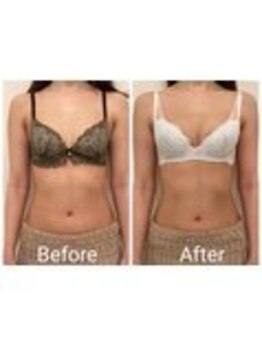 美人バスト 表参道店/バストアップ症例/育乳/1回目