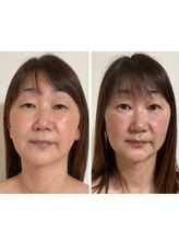 美人バスト 旭川店/【小顔コルギ】4980円クーポン