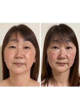 美人バスト 旭川店/【小顔コルギ】4980円クーポン