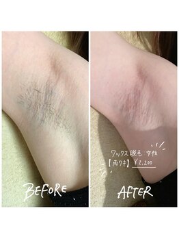 トータルビューティーサロン マイスター(MEISTER)/Wax脱毛ワキ