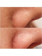 クリード(CLEAD)/毛穴洗浄☆ハイドラフェイシャル