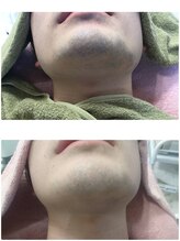 メンズアンドレディース エステティックサロン ティアラ(TiaLa)/人気の男子脱毛♪