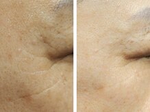 シミ・毛穴改善&美白フェイシャルサロン/目元の笑いしわをすっきり♪