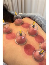 ハリカ 神戸三宮(harica)/吸玉（症状に合わせて）