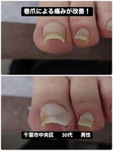 巻き爪じゅん 船橋店/巻き爪による痛みが改善！
