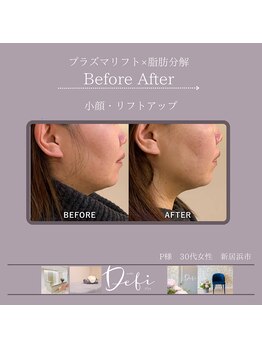 デフィ(Defi)/プラズマ×脂肪分解