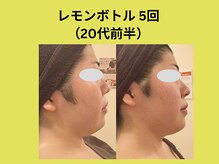 アユアランリンク 札幌中島公園店/レモンボトル5回