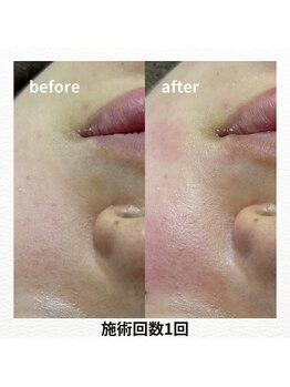 薫風 大阪豊中店/顔WAX